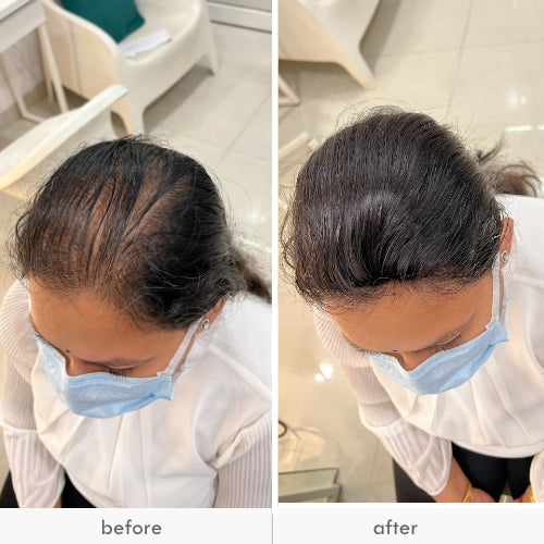 Before and after images showing a woman with and without a hair patch to cover thinning hair.