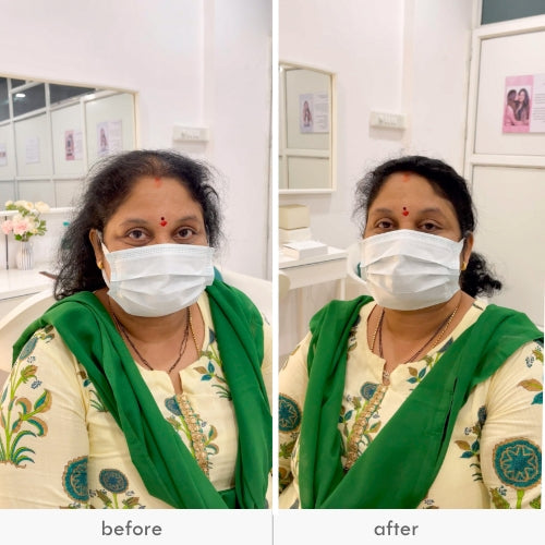 Woman wearing a mask, showing before and after results of hair topper application