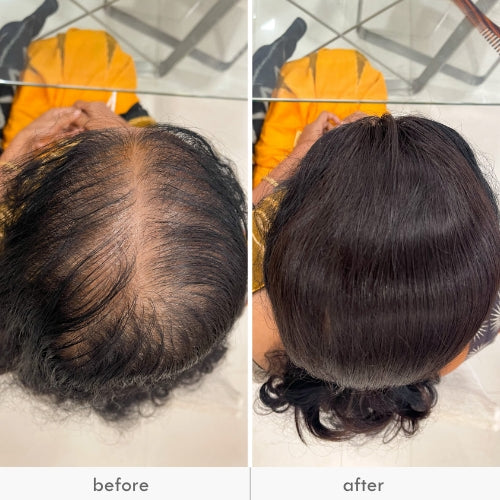 Before and after images of a person showing the top of their head with thinning hair and then with fuller hair.