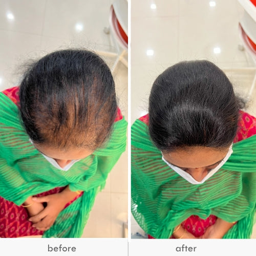 Woman before and after hair topper showing fuller hair on the top of her head
