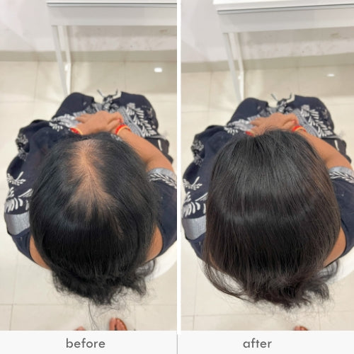 Before and after images of a woman showing hair thinning and then fuller hair with a hair patch.
