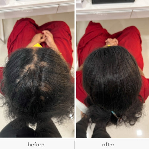 Before and after images of a person showing hair thinning and improved hair volume.