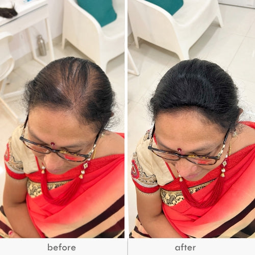 Before and after image of a woman showing hair thinning treatment results